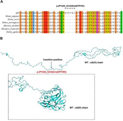 Molecular dynamics and minigene assay of new splicing variant c.4298-20T>A of COL4A5 gene that cause Alport syndrome